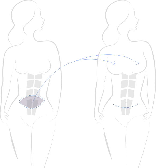 DIEP Flap for Breast Reconstruction