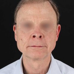All Me Facelift Before & After Patient #450