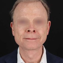 All Me Facelift Before & After Patient #450