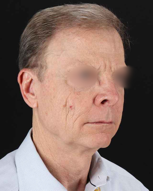 All Me Facelift Before & After Patient #450