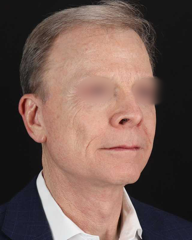 All Me Facelift Before & After Patient #450