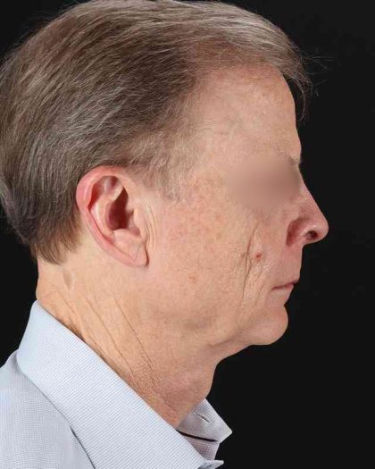 All Me Facelift Before & After Patient #450