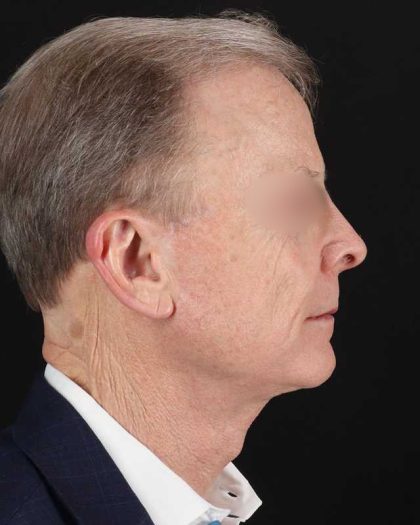 All Me Facelift Before & After Patient #450
