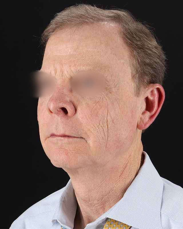 All Me Facelift Before & After Patient #450