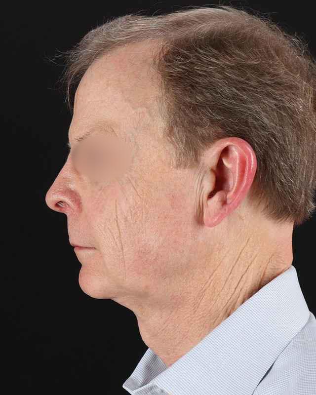 All Me Facelift Before & After Patient #450