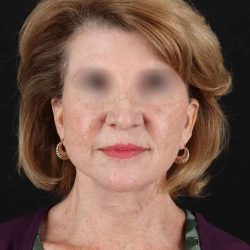 All Me Facelift Before & After Patient #240