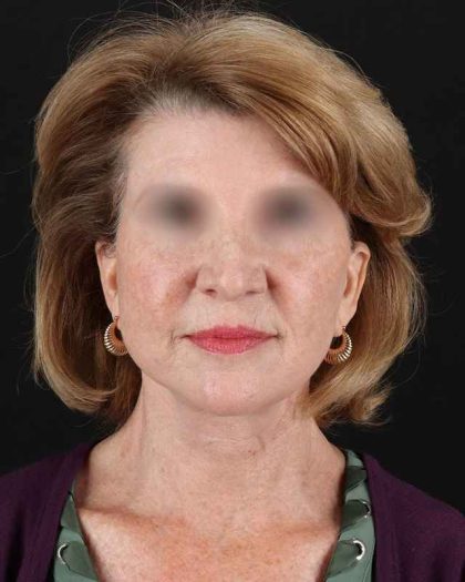 All Me Facelift Before & After Patient #240