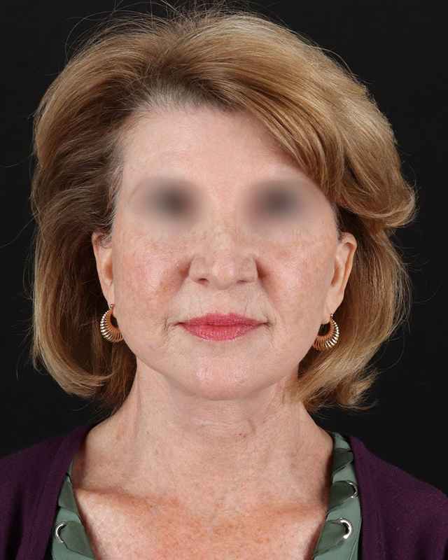 All Me Facelift Before & After Patient #240
