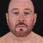 All Me Facelift Before & After Patient #343