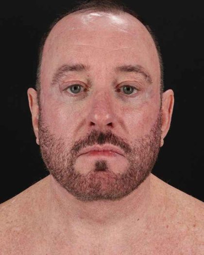 All Me Facelift Before & After Patient #343