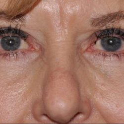 Blepharoplasty (Eyelid Surgery) Before & After Patient #930