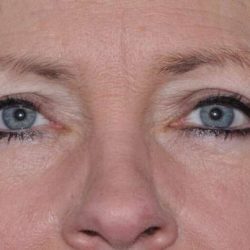 Blepharoplasty (Eyelid Surgery) Before & After Patient #937