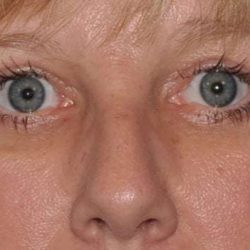 Blepharoplasty (Eyelid Surgery) Before & After Patient #944
