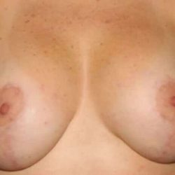 Breast Lift Before & After Patient #975