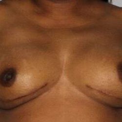 Nipple Areola Preservation (NAP) Before & After Patient #981
