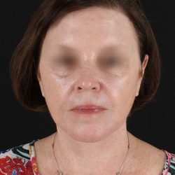 All Me Facelift Before & After Patient #354