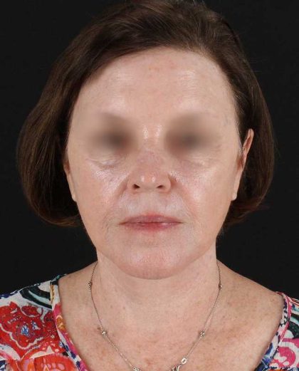 All Me Facelift Before & After Patient #354