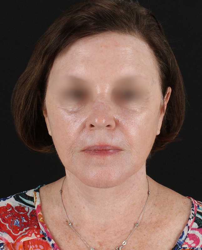 All Me Facelift Before & After Patient #354
