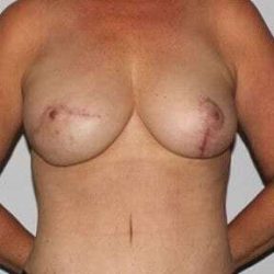 Nipple Areola Preservation (NAP) Before & After Patient #990