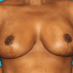 Breast Reduction With Lift Before & After Patient #996