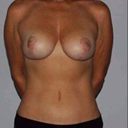 Breast Reduction With Lift Before & After Patient #1003