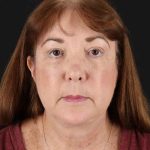 All Me Facelift Before & After Patient #366