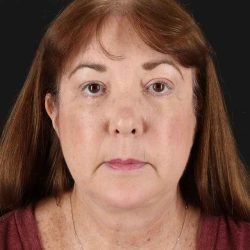 All Me Facelift Before & After Patient #366