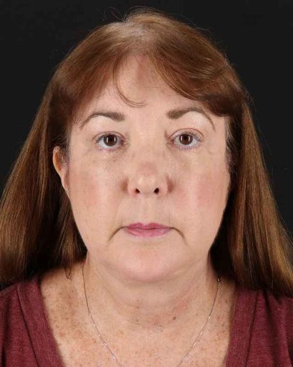 All Me Facelift Before & After Patient #366