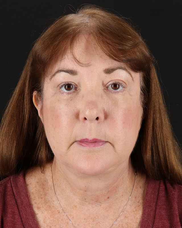 All Me Facelift Before & After Patient #366
