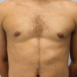 Gynecomastia Before & After Patient #1070