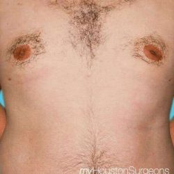 Gynecomastia Before & After Patient #1075