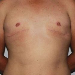 Gynecomastia Before & After Patient #1080