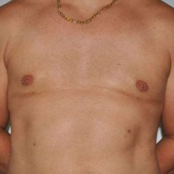 Gynecomastia Before & After Patient #1085