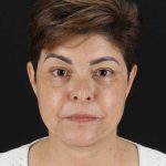 All Me Facelift Before & After Patient #373