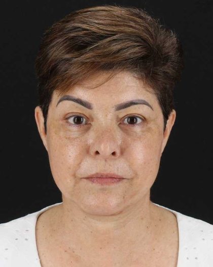 All Me Facelift Before & After Patient #373