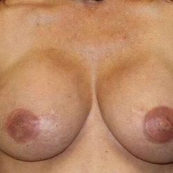 DIEP Flap Before & After Patient #1124