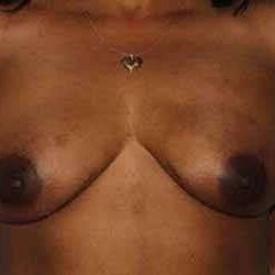 DIEP Flap Before & After Patient #1130