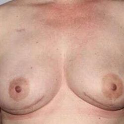 DIEP Flap Before & After Patient #1133