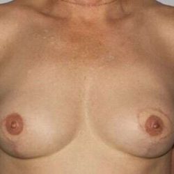 DIEP Flap Before & After Patient #1136