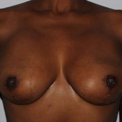 DIEP Flap Before & After Patient #1145