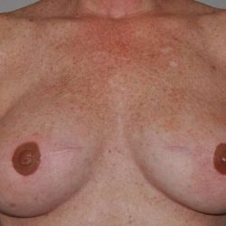DIEP Flap Before & After Patient #1148