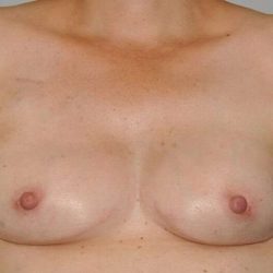 DIEP Flap Before & After Patient #1157