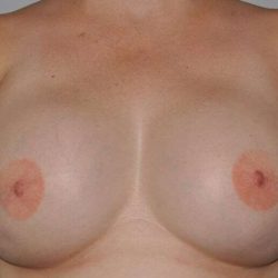DIEP Flap Before & After Patient #1166