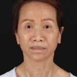 All Me Facelift Before & After Patient #395