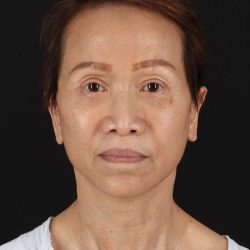 All Me Facelift Before & After Patient #395