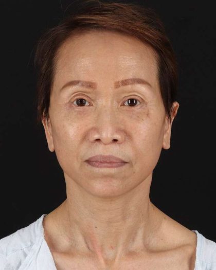All Me Facelift Before & After Patient #395
