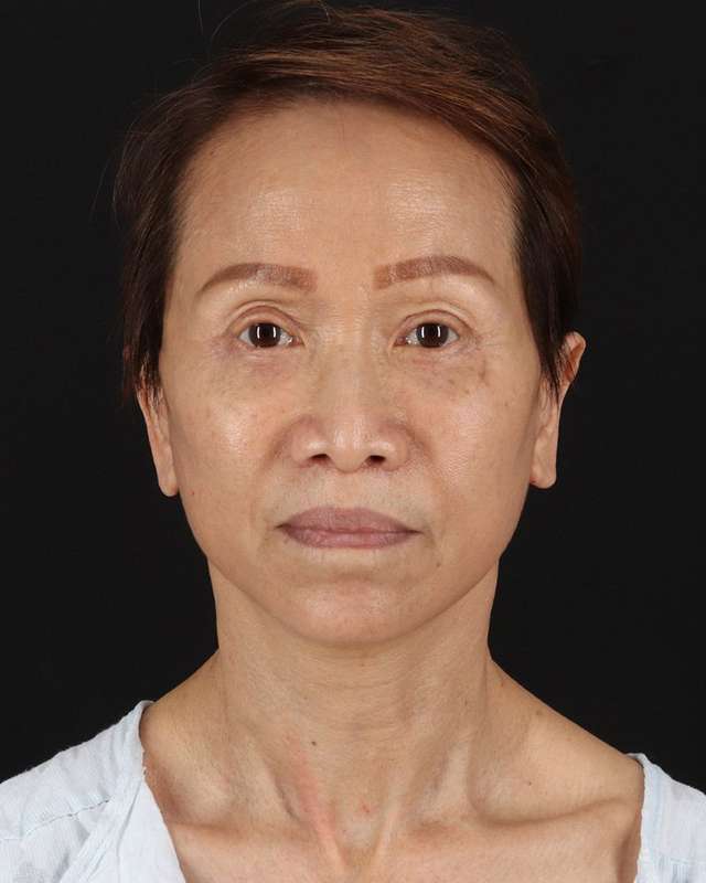 All Me Facelift Before & After Patient #395