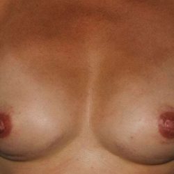 DIEP Flap Before & After Patient #1172