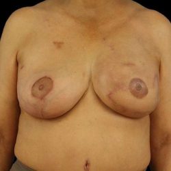 DIEP Flap Before & After Patient #1183