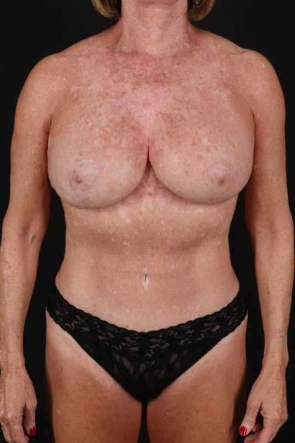 All Me Augmentation Before & After Patient #1190